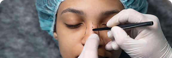 rhinoplasty-surgery